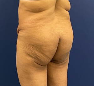 Brazilian-Butt-Lift-Case--215 | Before Brazilian Butt Lift 2