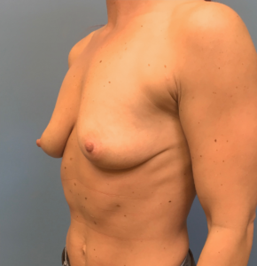 Case--17251 | Before Breast Augmentation 2