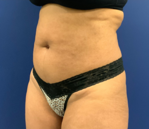 Tummy-Tuck-Case--21755 | Before Tummy Tuck 2