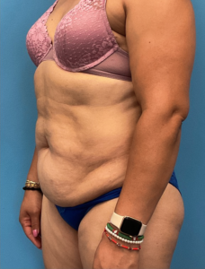 Tummy-Tuck-Case--25988 | Before Tummy Tuck 2