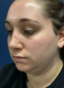 Submental-Liposuction-Case--29107 | Before Submental Liposuction 1