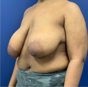 Breast-Reduction-Case--27281 | Before Breast Reduction 2