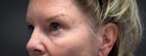 Blepharoplasty-Case--7015 | Before Eyelid Surgery 2