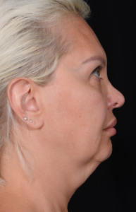 Facelift-Case--362 | Before Facelift 2