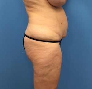 Case--248 | Before Liposuction 2