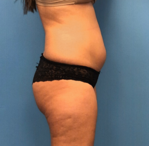 Lipo-360-Case--277 | Before Liposuction 2