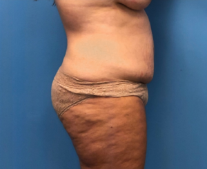 Case--252 | Before Mommy Makeover 2