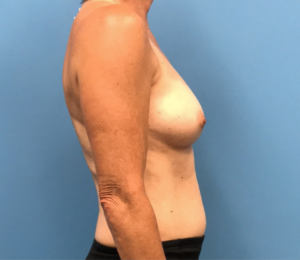 Breast-Reconstruction-Case--309 | Before Breast Reconstruction 2