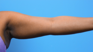 Case--279 | Before Liposuction 2