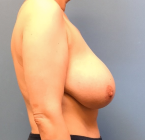 Breast-Reduction-Case--242 | Before Breast Reduction 2