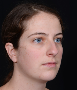 Rhinoplasty-Case--381 | Before Rhinoplasty 2