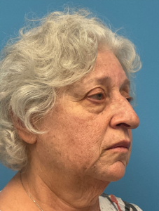 Rhinoplasty-Case--25467 | Before Rhinoplasty 1