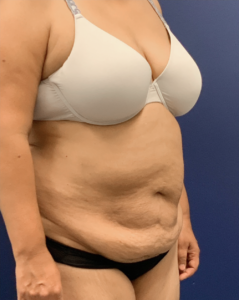 Liposuction-Tummy-Tuck-Case--25576 | Before Liposuction 2