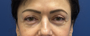 Lower-Blepharoplasty-Case--26939-1 | Before Eyelid Surgery 2