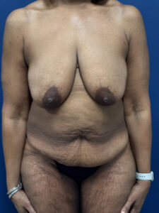 Abdominoplasty-Case--4952 | Before Tummy Tuck 1