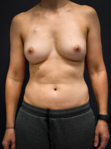 Bilateral-Mastectomy-Case--7380 | Before Breast Augmentation With Lift 1