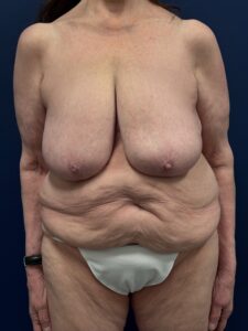 Abdominoplasty-Case--2664 | Before Tummy Tuck 1