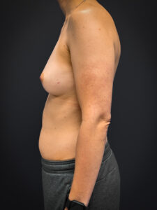Bilateral-Mastectomy-Case--7380 | Before Breast Augmentation With Lift 2