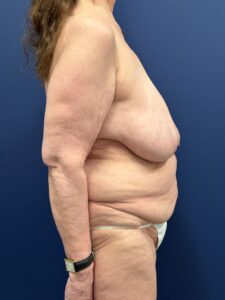 Abdominoplasty-Case--2664 | Before Tummy Tuck 2