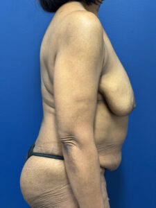 Abdominoplasty-Case--4952 | Before Tummy Tuck 2