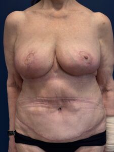 Abdominoplasty-Case--2664 | After Tummy Tuck 1