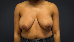 Breast-Reduction-Case--7089 | Before Breast Reduction 1