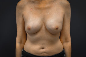 Breast-Reconstruction-Case--5261 | After Breast Reconstruction 1