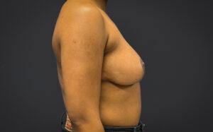 Breast-Reduction-Case--7089 | After Breast Reduction 2