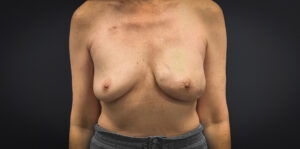 Breast-Reconstruction-Case--5261 | Before Breast Reconstruction 1