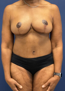 Abdominoplasty-Case--4952 | After Tummy Tuck 1