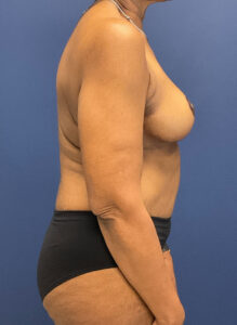 Abdominoplasty-Case--4952 | After Tummy Tuck 2