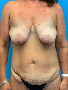 Abdominoplasty-Case--7009 | Before Tummy Tuck 1