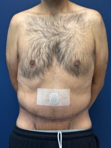 Abdominoplasty-Case--4899 | After Tummy Tuck 1