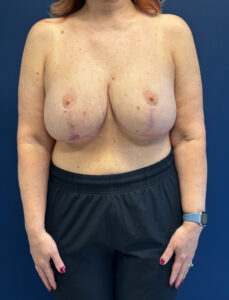 Abdominoplasty-Case--4899 | After Tummy Tuck 1