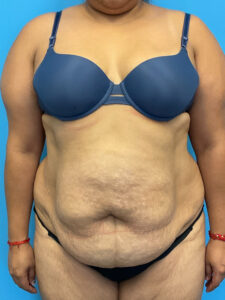 Abdominoplasty-Case--9547 | Before Dr. Frank Albino 1