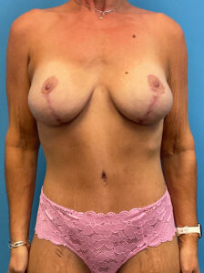 Abdominoplasty-Case--7009 | After Tummy Tuck 1