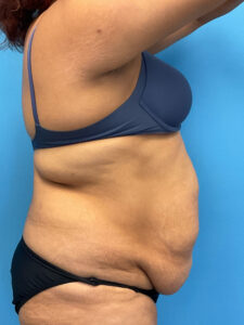 Abdominoplasty-Case--9547 | Before Dr. Frank Albino 2