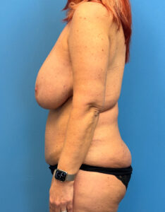 Abdominoplasty-Case--4899 | Before Tummy Tuck 2