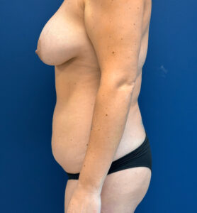 Abdominoplasty-Case--1050 | Before Tummy Tuck 2