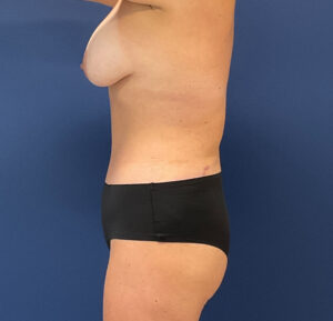 Abdominoplasty-Case--1050 | After Tummy Tuck 2