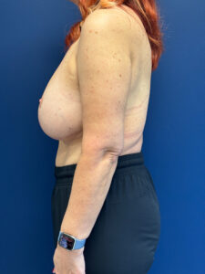 Abdominoplasty-Case--4899 | After Tummy Tuck 2