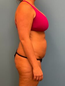 Abdominoplasty-Case--3117 | Before Tummy Tuck 2