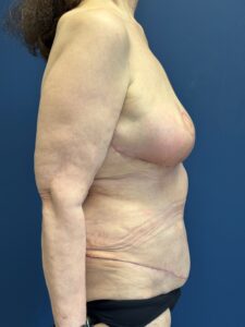 Abdominoplasty-Case--2664 | After Tummy Tuck 2