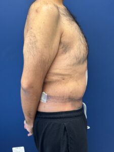 Abdominoplasty-Case--4899 | After Tummy Tuck 2