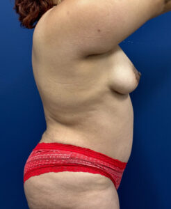 Abdominoplasty-Case--9547 | After Dr. Frank Albino 2